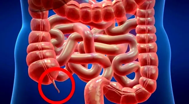 Cuando se órgano se inflama se genera una apendicitis. Cuando se órgano se inflama se genera una apendicitis.