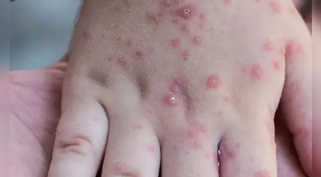 Entre sus principales síntomas está la fiebre y erupciones en la piel.