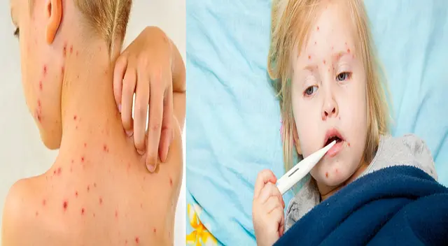 A tener mucho cuidado con el sarampión.