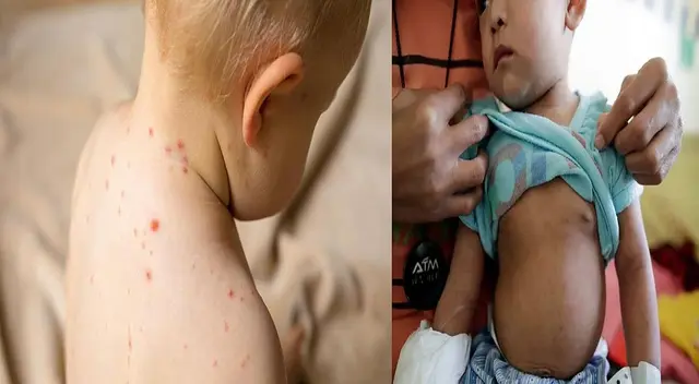 La rubéola es por lo general leve y con pocos síntomas evidentes. La rubéola es por lo general leve y con pocos síntomas evidentes.