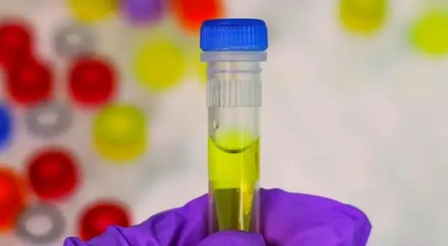 Este estudio del equipo de la Universidad de East Anglia participaron más de 600 pacientes con y sin cáncer de próstata. Este estudio del equipo de la Universidad de East Anglia participaron más de 600 pacientes con y sin cáncer de próstata.