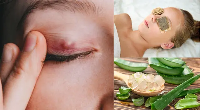 El orzuelo puede causar una secreción purulenta.