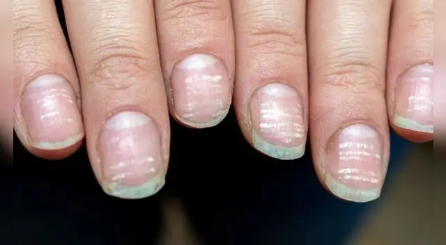 Uno de los síntomas que manifiesta el COVID-19 de desarrolla en las uñas.