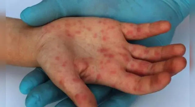 Conoce qué es la viruela del mono y por qué es tan peligrosa.