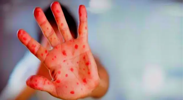 Según Public Health England revela que el primer caso de viruela de mono data del año 1958.