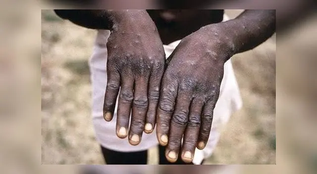 Viruela del mono: Minsa y EsSalud prevén acciones ante posibles casos de la enfermedad