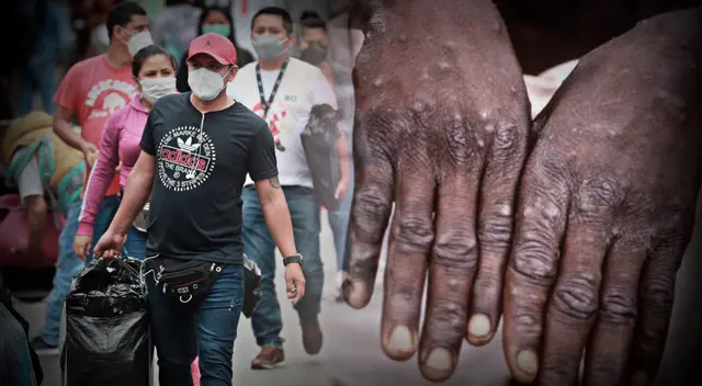 La viruela del mono ya viene afectando a países de Europa y Norteamérica enciendo las alarmas en todo el mundo.