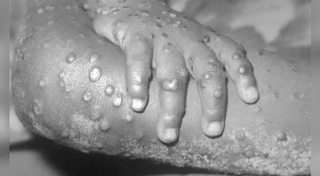 La OMS señala que la viruela del mono es una enfermedad preocupante.