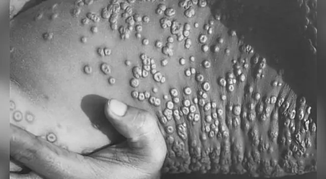 Conoce cuánto dura la viruela del mono en una persona que lo adquiere.