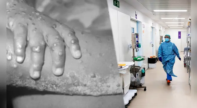 Alerta. La viruela del mono se expande con casi medio centenar de casos en Portugal.