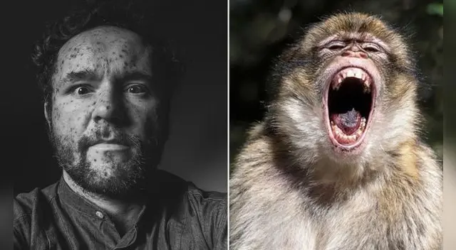 La viruela del mono se sigue propagando por el mundo.