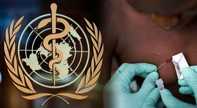 OMS reveló que existen más de 250 casos confirmados y sospechosos de viruela del mono.