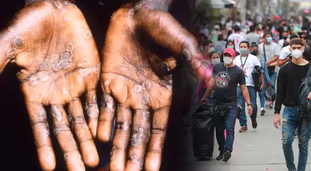 Gobierno aseguró que esta analizando la posible lleagada de la viruela del mono