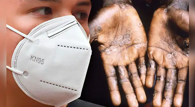 Bolivia estaría en sospecha del primer caso de viruela del mono en un hombre de 26 años.