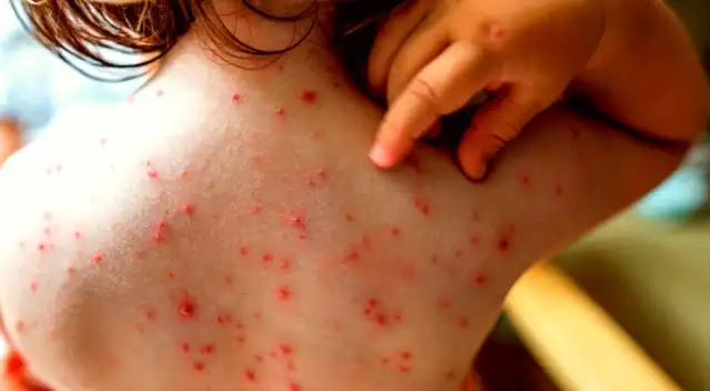 Una rara enfermedad que no es una amenaza sanitaria global pero sí una preocupación por su rebrote.