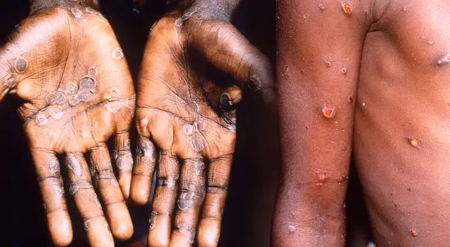 Fiebre y ronchas en la piel son algunos de los síntomas de la enfermedad viruela del mono. Fiebre y ronchas en la piel son algunos de los síntomas de la enfermedad viruela del mono.