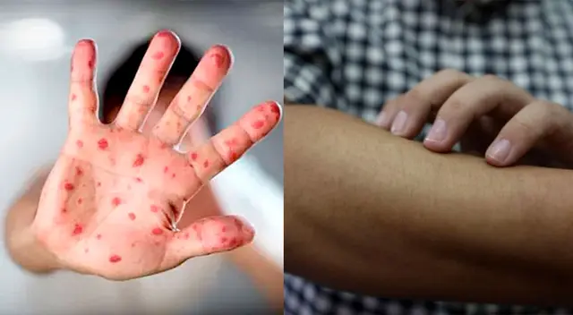 Minsa lanza alerta epidemiológica ante riesgo de ingreso de viruela de mono al Perú