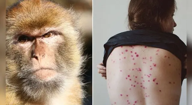 Los niños y adultos mayores podrían ser los más vulnerables frente a la viruela del mono.