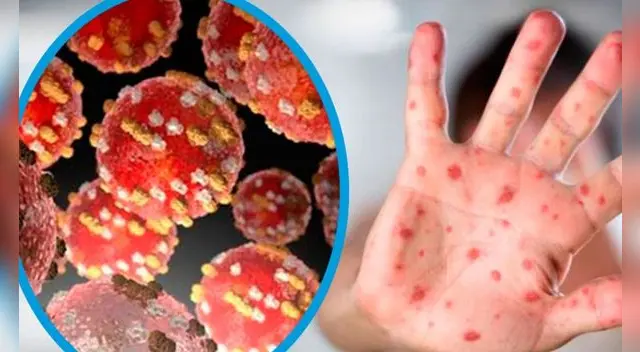 Piura: EsSalud en alerta para atender casos sospechosos de viruela del mono