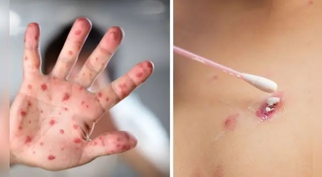 La OMS recomienda evitar el contacto con las personas que han contraído la enfermedad.