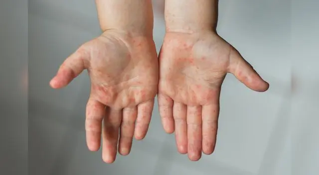 Viruela del Viruela del mono en Perú: descartan al menos 5 casos de pacientes sospechosos en Lima