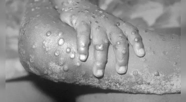 La viruela del mono es menos letal que la viruela humana.