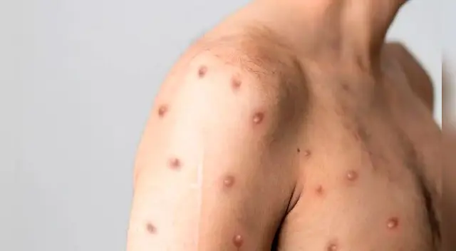 El brote de la viruela del mono es “poco probable” que se convierta en una pandemia, dice la OMS.