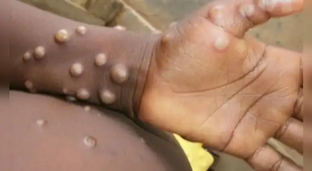 La viruela del mono es una enfermedad originaria de África.
