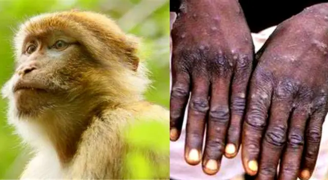 La viruela del mono sigue en alerta para las autoridades sanitarias