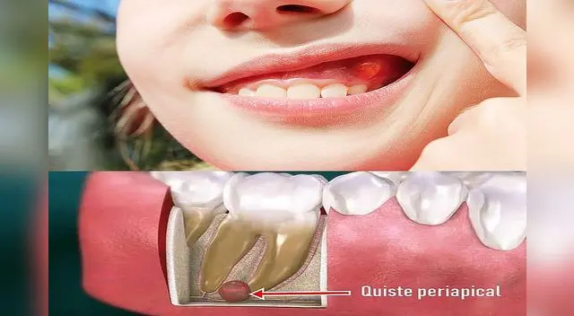 Los quistes dentales generan complicaciones. Los quistes dentales generan complicaciones.