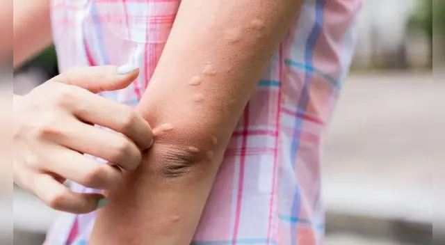 La picadura de mosquitos es muy molesta sobre todo cuando carga el