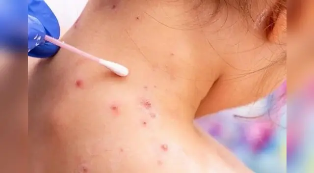 Chile confirma el primer caso de la viruela del mono.