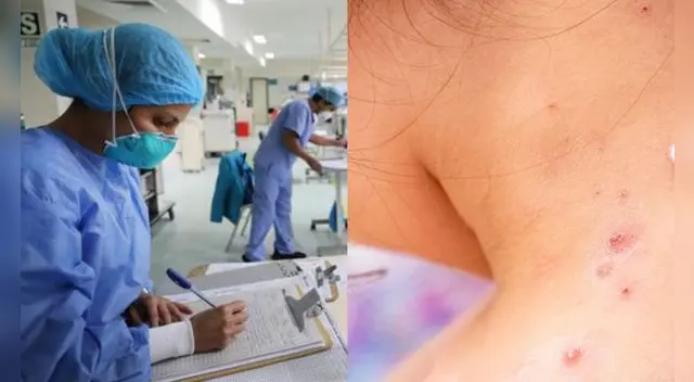 La viruela del mono es una enfermedad que sigue su propagación en todo el mundo.