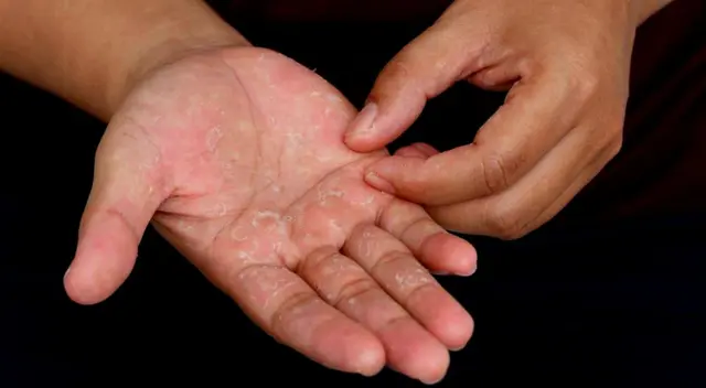 Procura no usar productos de higiene que tengan menos consevantes. Procura no usar productos de higiene que tengan menos consevantes.