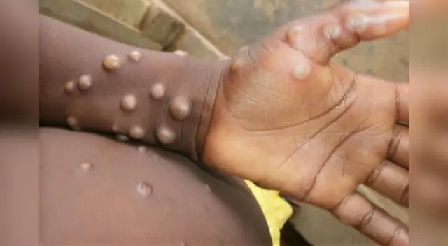 Viruela del mono: Esta enfermedad es endémica del continente africano. Viruela del mono: Esta enfermedad es endémica del continente africano.