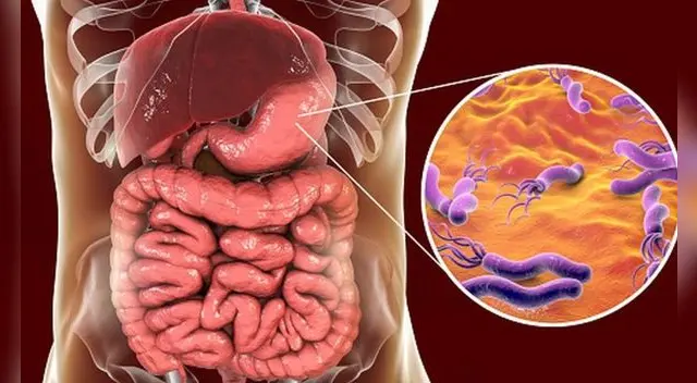 H. pylori: Es un microorganismo al que se le atribuye el desarrollo de cáncer de estómago.