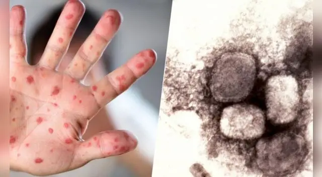 La viruela del mono llegó a Perú.