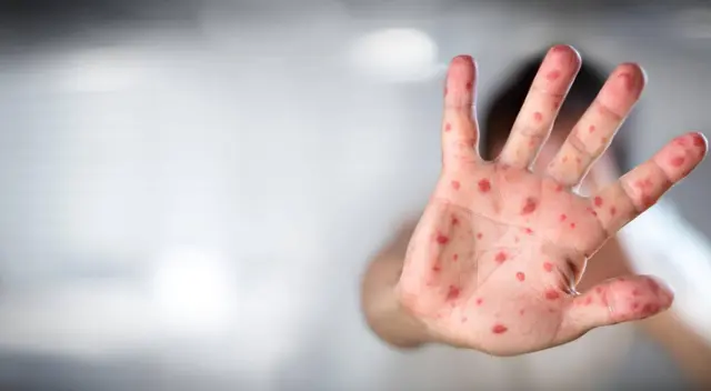 Viruela del mono: se elevan a tres los casos confirmados por esta enfermedad Viruela del mono: se elevan a tres los casos confirmados por esta enfermedad