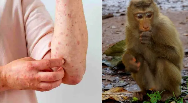 La viruela del mono sigue avanzando a varias naciones.