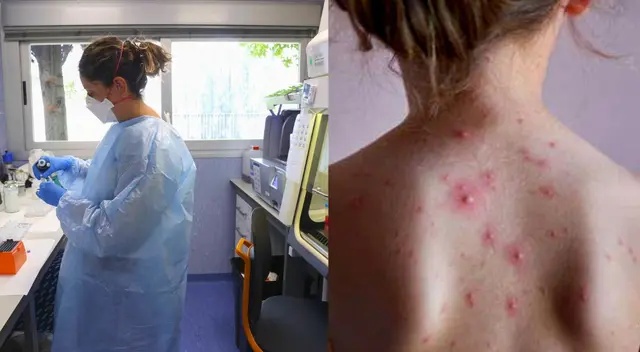 De tener la viruela del mono debe guardar aislamiento.