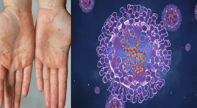 Tres casos confirmados de la viruela del mono en el Perú.