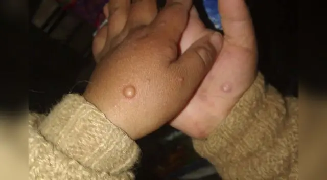 Entre uno de los principales síntomas son las llagas y erupciones cutáneas. Crédito: Andina