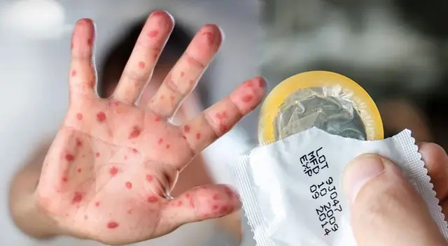 Preservativo protege infecciones como el VHI, pero no la enfermedad de la viruela del mono. Preservativo protege infecciones como el VHI, pero no la enfermedad de la viruela del mono.