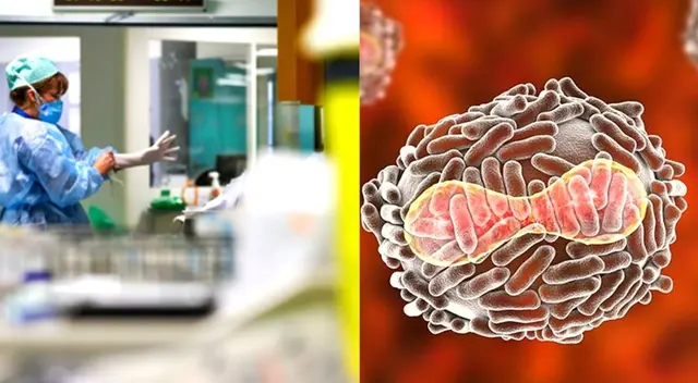 Hay por ahora 15 casos confirmados de viruela del mono Hay por ahora 15 casos confirmados de viruela del mono