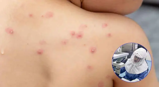 OMS señala que la tasa letalidad por viruela símica ronda entre el 0% y el 11%.
