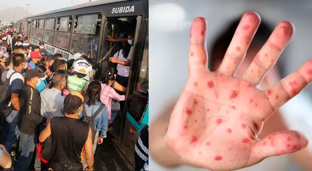 Minsa exhorta a la ciudadanía a acudir a un centro de salud cercano en caso se tenga los síntomas.