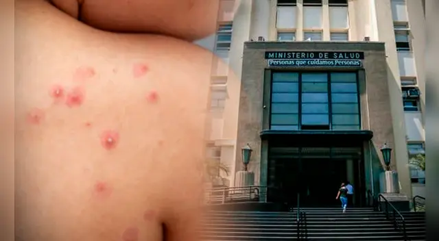 Viruela del Mono se incrementa en el Perú. Viruela del Mono se incrementa en el Perú.