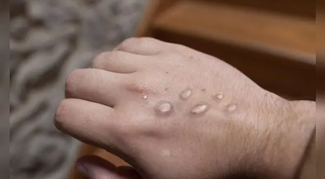 Los casos de viruela del mono asciende a casi 50.
