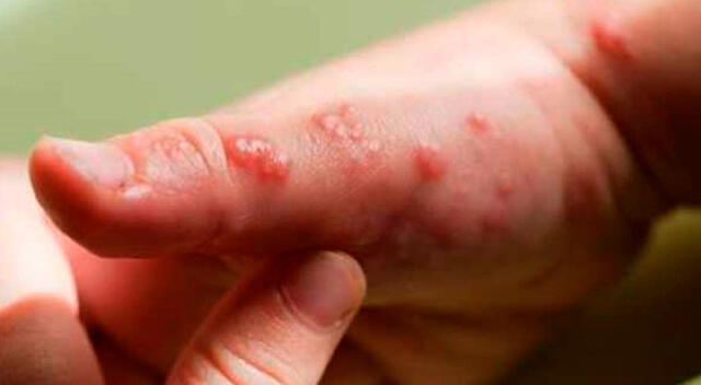 Especialistas recominedan tomar medidas de prevención.   