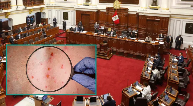 Trabajador de Congreso se contagio de viruela del mono, pero ya viene siendo monitoreado por el Minsa. Trabajador de Congreso se contagio de viruela del mono, pero ya viene siendo monitoreado por el Minsa.